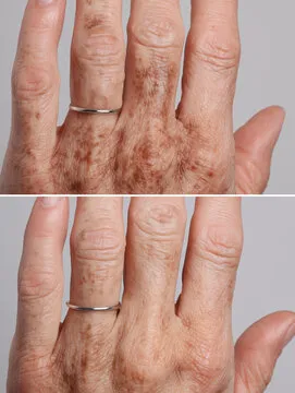 Before & After images showing hands: one with visible dark spots, and one with visibly reduced or faded spots