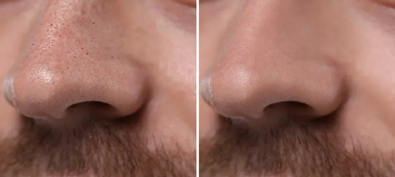 Blackhead treatment, before and after. Collage with photos of man, closeup view
